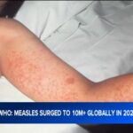 With measles cases surging globally, health officials tell us what LA County is doing right