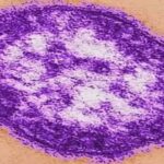 Central Valley health departments monitoring for measles