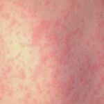 Gregg County Health Department confirms 19-year-old tested from Upshur County positive for measles