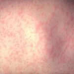 Health officials investigating person with measles who ate at DC restaurant