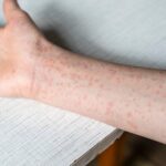 Second measles case confirmed in Ingham County, Michigan, health officials say