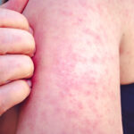 Montana health officials confirm five cases of measles